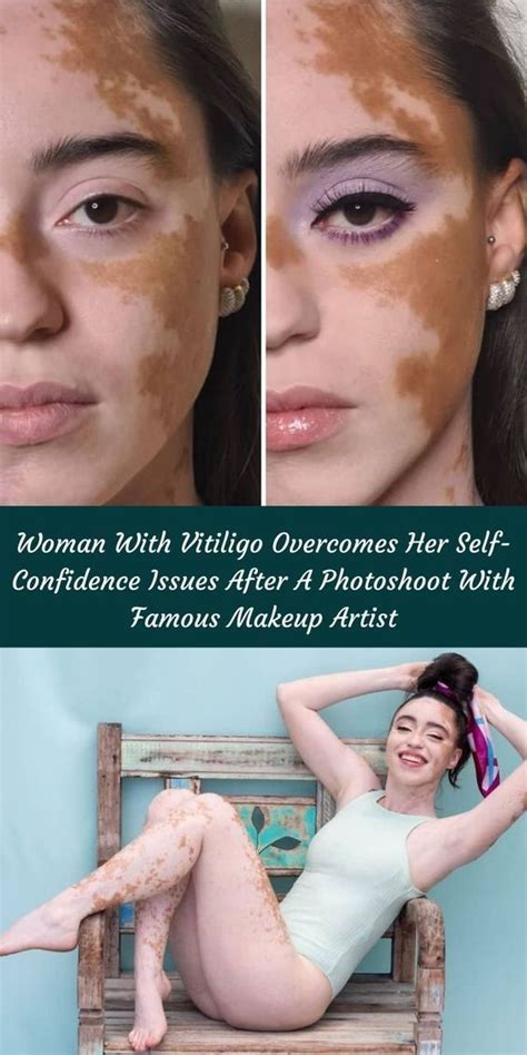 35 Beautiful Women With Vitiligo Shot By A Photographer Who。